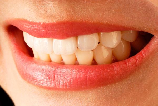 Qué carillas dentales postizas duran más tiempo? - ClinicaForumDental