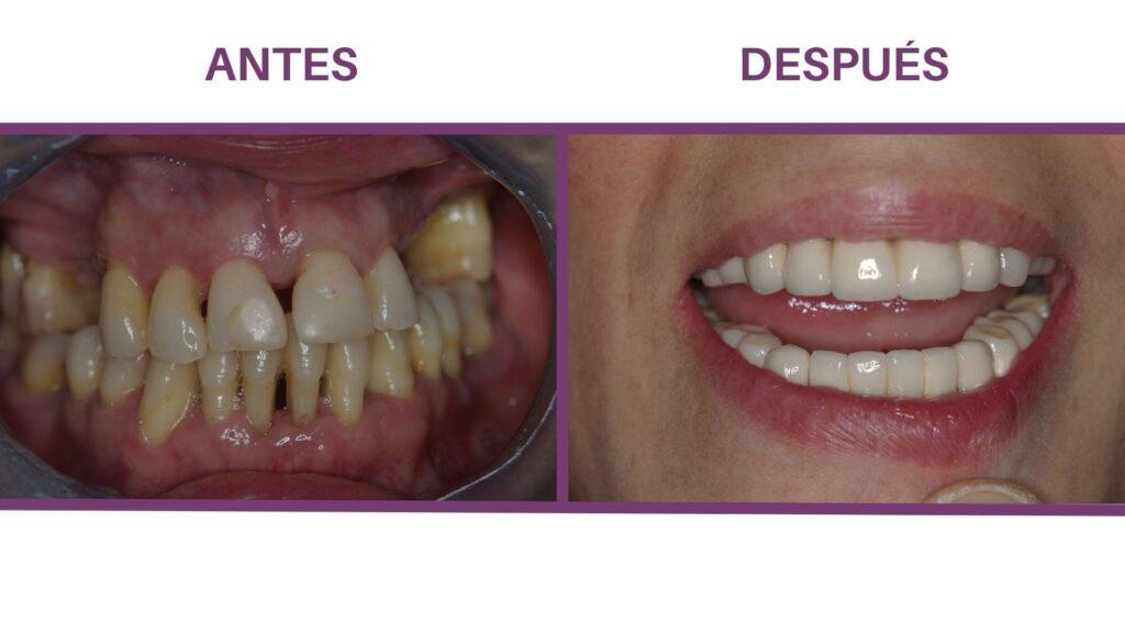 tratamientos periodontales