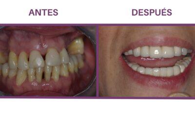 ¿En qué consiste la periodoncia dental y cómo te ayuda a mantener una boca sana?