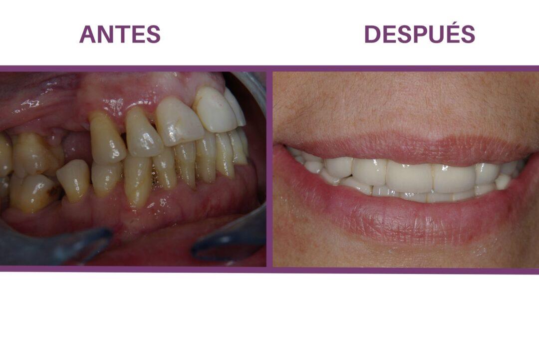 Tipos de tratamientos periodontales