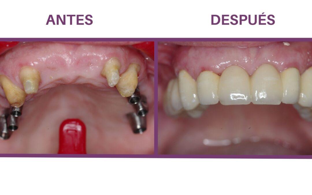 implantología dental