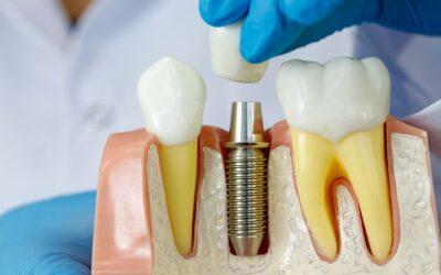 ¿Cuáles son los mejores implantes dentales para ti?