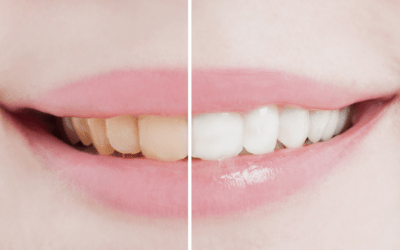 ¿Cuánto tiempo debe pasar entre blanqueamientos dentales?